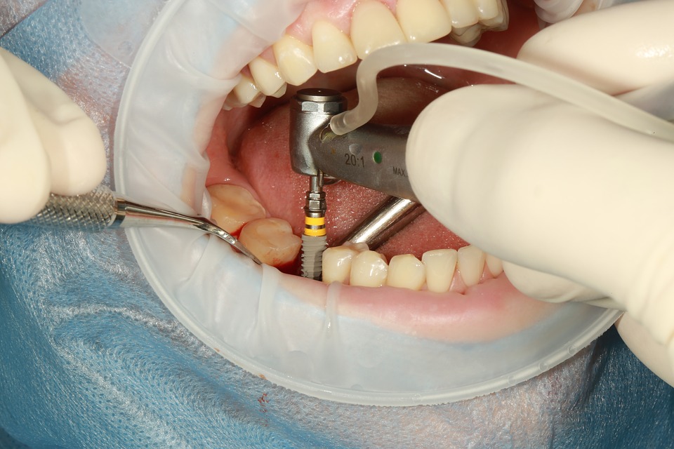 Dental Implant Treatment